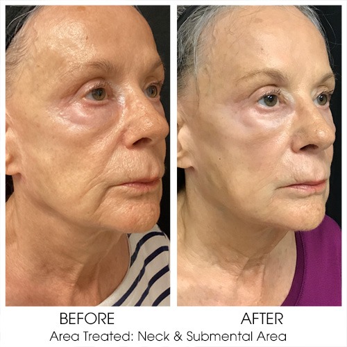 Before + After Gallery: Face